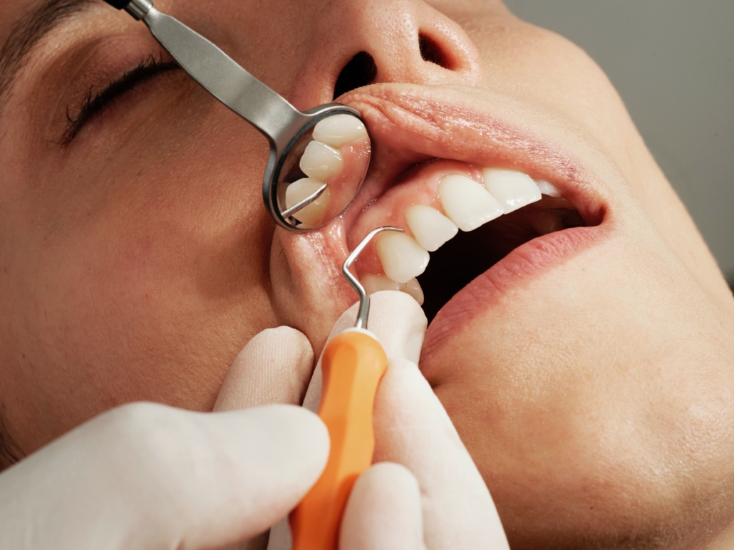 woman receiving a dental cleaning.