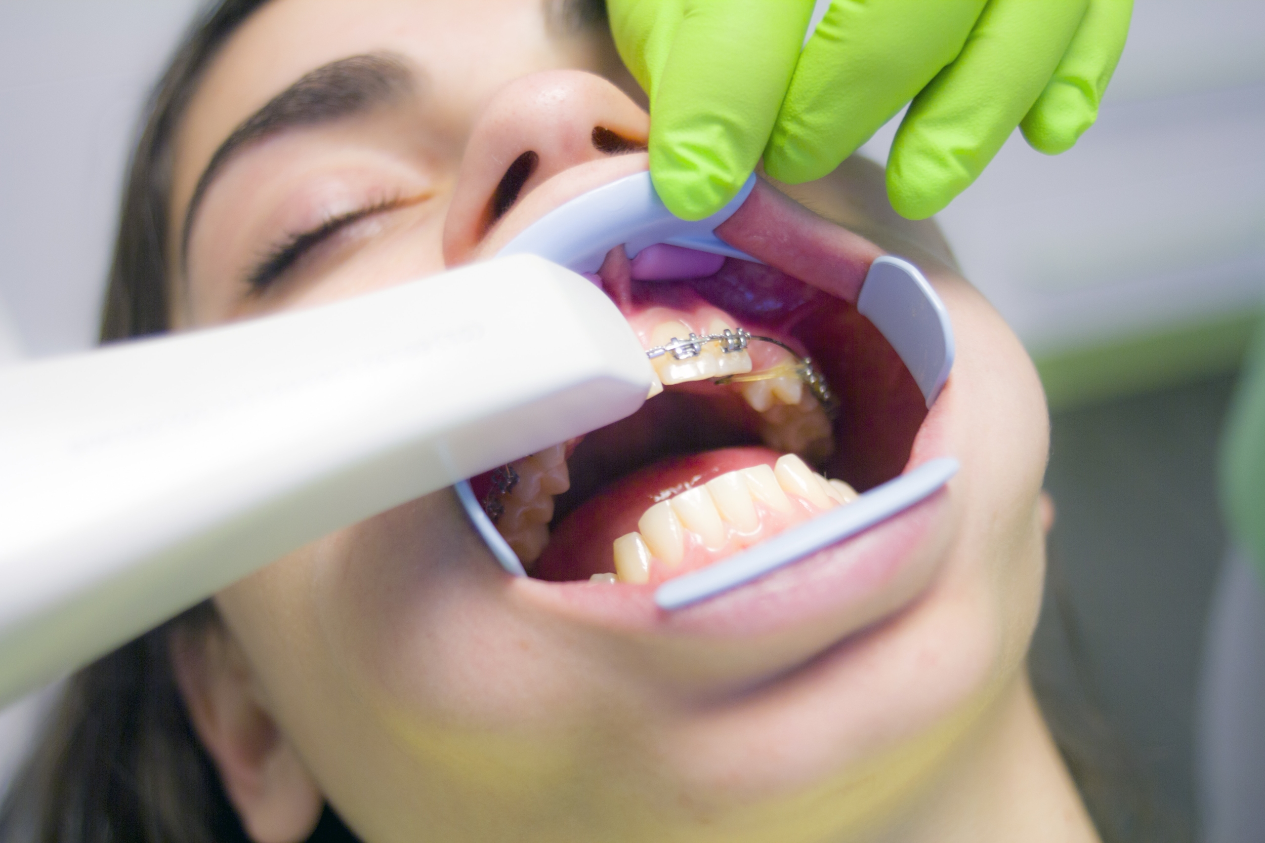 New Canada Dental Benefit Program – Who Qualifies?