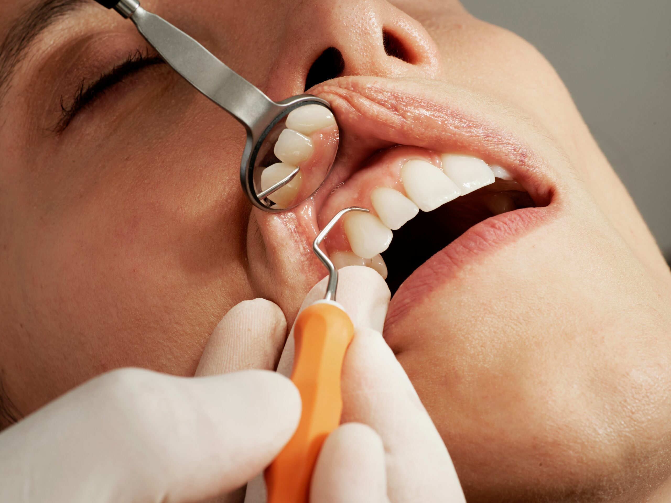 The Canadian Dental Care Plan: Who’s Eligible and What’s Covered