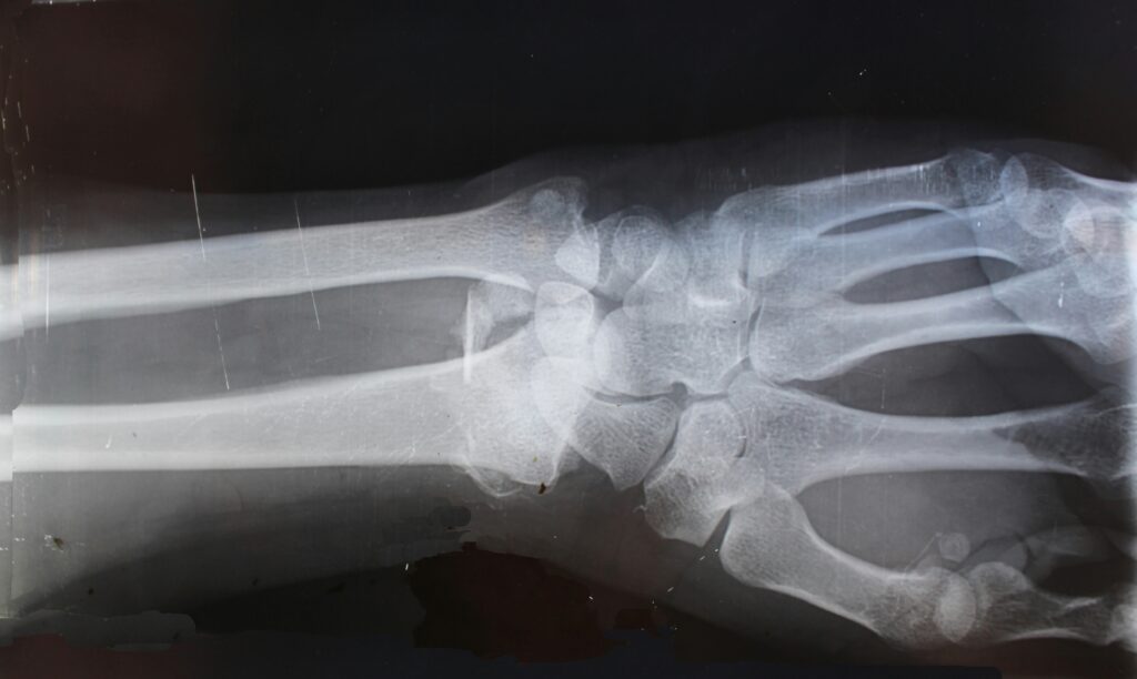 an xray of a broken bone due to a workplace injury